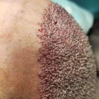 مشاوره و کاشت موی تخصصی ، بدون واسطه|خدمات زیبایی و سلامت|تهران, فردوس|دیوار