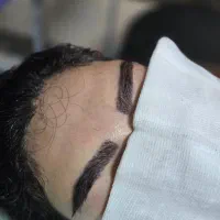 کاشت مو ابرو ریش مزوتراپی و پی آرپی جشنواره پاییزه