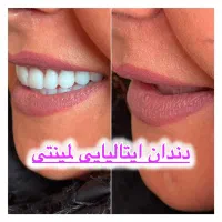 دندانسازی/دندان مصنوعی/جوان پسند/لمینتی/چکی
