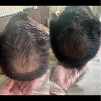 درمان ریزش مو جوانسازی پوست با پی آر پی ومزوژل