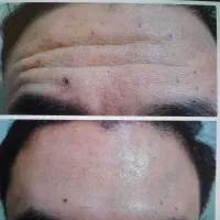 زیبایی به سبک اصفهان ،بوتاکس،فیلر توسط پزشک