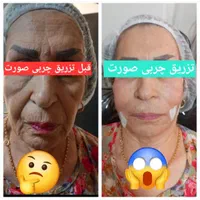 جشنواره مرکز تزریق چربی صورت ،ژل ،بوتاکس.prp|خدمات آرایشگری و زیبایی|کرج, اصفهانی‌ها|دیوار