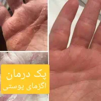 پک درمان اگزمای پوستی