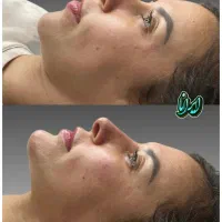 ساکشن غبغب توسط جراح (کلنیک ایرانا)|خدمات آرایشگری و زیبایی|یاسوج, |دیوار