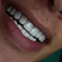 کامپوزیت، لمینیت، روکش و دیگر خدمات دندانپزشکی