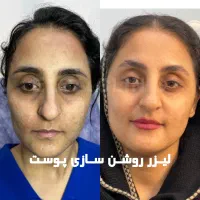تزریق چربی ،ساکشن غبغب ،بلفاروپلاستی،تزریق ژل