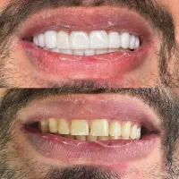 کامپوزیت ۴۰درصد تخفیف|خدمات آرایشگری و زیبایی|خرم‌آباد, |دیوار