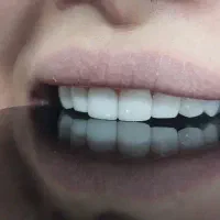کامپوزیت دندان و بلیچینگ در اهواز