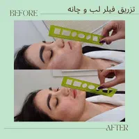 تزریق ژل بوتاکس فیلر چشم هایفو مزو جوانساز زاویه|خدمات آرایشگری و زیبایی|تهران, هفت حوض|دیوار