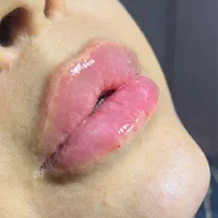 ۵۰٪تخفیف ژل بوتاکس لیزر موهای زائذ هایفو فشیال