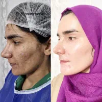 لیزرco2جای جوش ولک کلینیک رایدودکتربهنام روایی