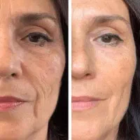 درمان تخصصی آفتاب‌سوختگی و لک‌ها