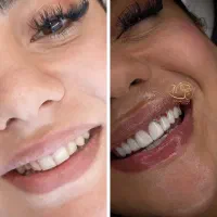 کلینیک تخصصی کامپوزیت دندان تمام اقساط در شیراز