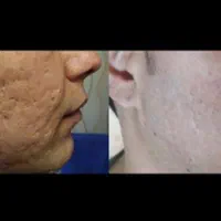 رفع جای جوش ،ریزش مو ،خال برداری برای آقایان|خدمات آرایشگری و زیبایی|خرمشهر, |دیوار