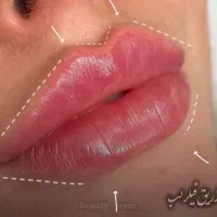 نیازمند مدل تزریق ژل و بوتاکس (فقط هزینه مواد)