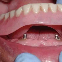 پروتز دندان مصنوعی( آقای عماد)|خدمات آرایشگری و زیبایی|سیرجان, |دیوار