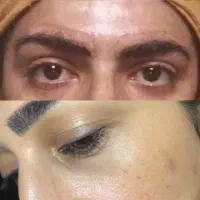 ریموو و کراتین و شیدلب و فیبروز خط چشم انجام میشود