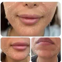 فیشال وپاکسازی تخصصی ودرمانی لک وآکنه واسکالپ سر
