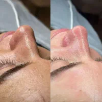 تخفیف ویژه فیشیال تخصصی پوست با بهترین مواد