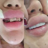دندانپزشکی،کامپوزیت فکی7200،روکش ،لمینت،عصب کشیی