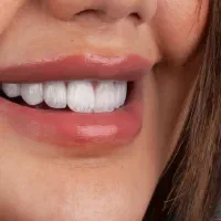 لمینیت دندان هالیوودی|خدمات آرایشگری و زیبایی|اصفهان, خواجو|دیوار