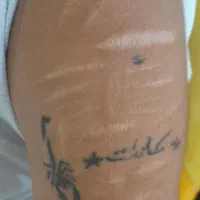 پاک کردن(ریمو) تتو با لیزر