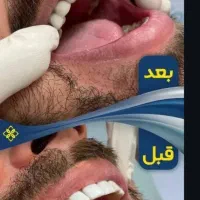 خدمات تخصصی ایمپلنت و اوردنچر دیجیتال|خدمات آرایشگری و زیبایی|کرج, جهان‌شهر|دیوار