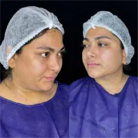 سوپرکانتور غبغب (وی لاین)