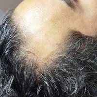 درمان ریزش مو|خدمات آرایشگری و زیبایی|رشت, بلوار گیلان|دیوار