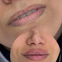 جشنواره تخفیفی فیلر بوتاکس و مزوژل