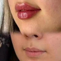 تزریق ژل و بوتاکس جوانسازی|خدمات آرایشگری و زیبایی|تهران, عبدل‌آباد|دیوار