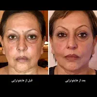 هایفوتراپی صورت و غبغب و شکم|خدمات آرایشگری و زیبایی|تبریز, |دیوار