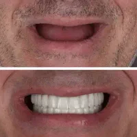 ساخت و تحویل دندان مصنوعی زیرنظر متخصص و دندانپزشک