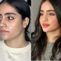 آف فیلر بوتاکس و prpو فیلربادی وچالگونه مطب