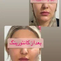 آف هفتگی تزریق ژل و بوتاکس و مزوژل جوانساز|خدمات آرایشگری و زیبایی|آمل, |دیوار