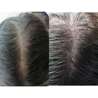 اسکالپ تخصصی در کلینیک پوست مو کاشت میکرو اسکالپ|خدمات آرایشگری و زیبایی|مشهد, شهید فرامرز عباسی|دیوار