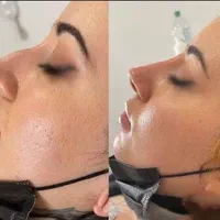 فیلر بینی  برطرف کردن قوز بینی  بینی شکسته و کج