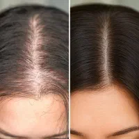 مراقبت حرفه‌ای پوست سر
