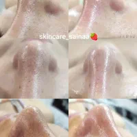 فیشیال تخصصی و پاکسازی پوست ، تخفیف اولین مراجعه