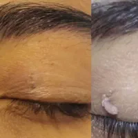 رفع خال میلیا و منگوله گوشتی  ویژه بانوان