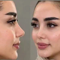 عمل جراحی بینی متخصص entپیزو/ فراصوت /التراسونیک