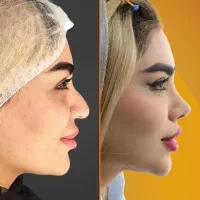 عمل جراحی بینی،صورت،پیکرتراشی