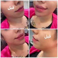 آموزش و خدمات ژل و بوتاکس|خدمات آرایشگری و زیبایی|زابل, |دیوار