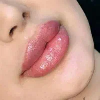 جشنواره تخفیفات ویژه ژل وبوتاکس|خدمات آرایشگری و زیبایی|گنبد کاووس, |دیوار