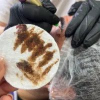 ریموو ابرو تک جلسه ای  تضمینی