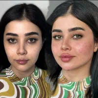 آف ویژه ژل وفیلرو بوتاکس به همراه اموزش