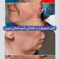 اندولیفت صورت و بدن با دستگاه یوفتون ایتالیا ۲۰۲۴