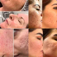 تخفیفات فیلر،بوتاکس،پی ار پی،مزوتراپی،prpتوسط پزشک