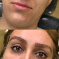 تزریق ژل و بوتاکس