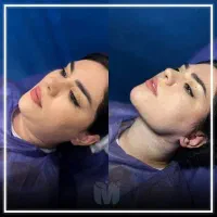 ساکشن غبغب نخ لیفت دائمی